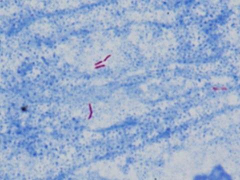 写真3.抗酸菌顕微鏡写真