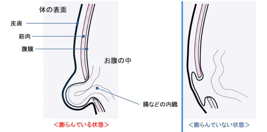 ヘルニア